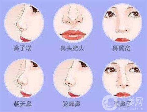 湖南省人民醫(yī)院整形美容科隆鼻*果如何？看價(jià)格表及案例實(shí)述