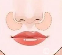 填充鼻基底的后遺癥？