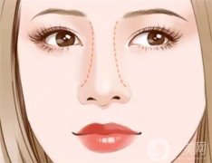 隆鼻為什么會穿孔？微創(chuàng)隆鼻危險嗎？