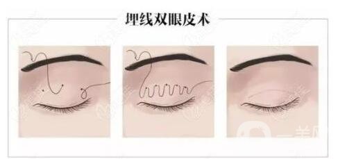 拉雙眼皮的危害是什么？術(shù)后注意事項(xiàng)有哪些？