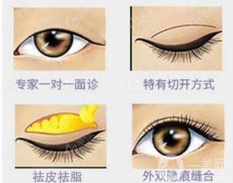微創(chuàng)去眼袋恢復(fù)要多久