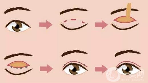 割雙眼皮注意事項(xiàng)有哪些 術(shù)后注意事項(xiàng)詳解