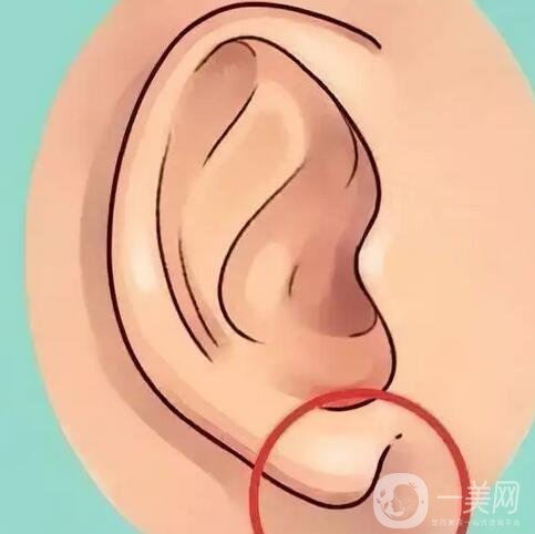 玻尿酸注射豐耳垂要注意什么？術(shù)后護(hù)理詳細(xì)介紹