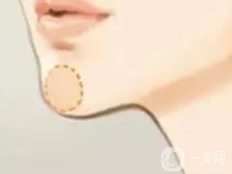 墊下巴術(shù)前準備有什么呢？