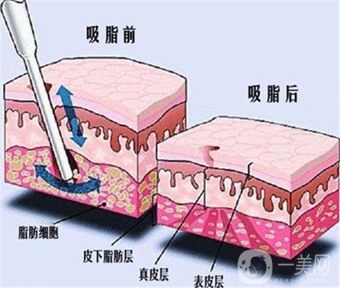 360環(huán)形抽脂手術(shù)大概要多少錢？