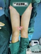 自從在醫(yī)院做了大腿吸脂手術(shù)以后，我終于擁有了兩條纖細(xì)筆直的漫畫腿