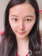在整個過程中不會感覺到什么疼痛，現(xiàn)在熱瑪吉已經發(fā)展到第五代了