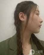 剛做完拉皮的這幾天真的是特別的不適應，因為每天都有在戴頭套