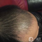 而我也是在這個(gè)時(shí)候出現(xiàn)的嚴(yán)重脫發(fā)，而且我覺得自己的情況要比當(dāng)初的爸爸更