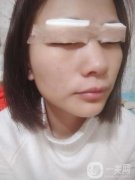心心念念的雙眼皮終于是做完了，對自己的雙眼皮一直以來都是特別的不滿意