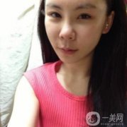 因為我自己身上的脂肪不是太多，所以醫(yī)生看到我這樣的面部直接給我推薦的是