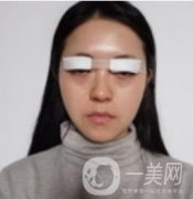 我來(lái)了，我來(lái)了，做的眼綜合，半個(gè)月才拆線(xiàn) 效果很好
