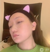 今天是術(shù)后第七天，縫線已經(jīng)拆線，醫(yī)生說恢復(fù)的不錯(cuò)