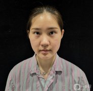 我的鼻子做了，前兩天沒敢洗臉