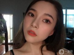 滿月打卡!30天恢復(fù)，鼻子還是很好的，鼻型和鼻腔的切口都很好，沒有異常不適