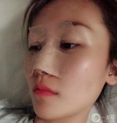鼻部修復(fù)第7天醫(yī)生說我恢復(fù)的很好,越來越羨慕自己，不知道當(dāng)初的勇氣是從哪