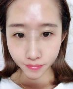 一直對自己的鼻子不滿意,雖然挺高，但是肉多
