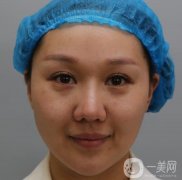 剛做完熱瑪吉的這幾天皮膚有一些緊致，臉看起來也是小了許多