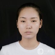 面部的小拉皮手術(shù)切口小，創(chuàng)傷小，恢復(fù)快