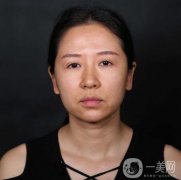 做完拉皮手術(shù)有10多天的時間，臉上的除皺皮膚緊致效果顯著