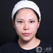面部拉皮手術(shù)的第二天，臉上有強(qiáng)烈的緊繃感覺