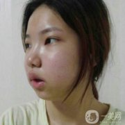 做了面部拉皮手術(shù)之后，感覺自己又回到了20歲的時(shí)候的肌膚