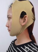 拉皮手術(shù)十六天了，恢復(fù)到現(xiàn)在已經(jīng)沒有那么的腫了