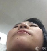 隆鼻術(shù)后兩個(gè)月，鼻子的高度剛剛好