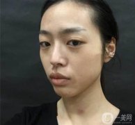 隆鼻術(shù)后一個(gè)月，鼻子大小弧度都還行