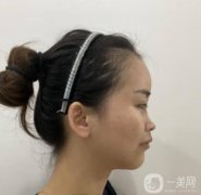 隆鼻時(shí)，美容效果可以更自然