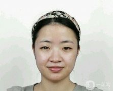 面部脂肪填充后半個(gè)月，臉就飽滿了