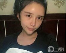 面部脂肪填充后，臉看起來(lái)很豐滿立體度有所提升