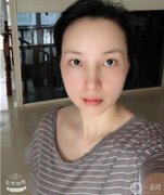 我以前做過鼻子整形，但我不滿意