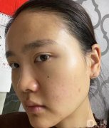 做完鼻子后，感覺效果出來了，鼻翼小很多