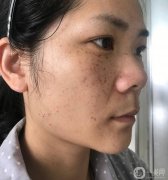 皮秒祛斑手術(shù)之前和手術(shù)過程中我都是一種遺傳性的雀斑