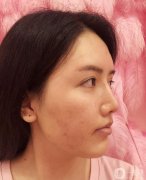 只要吃辣的，就容易長(zhǎng)痘，但是，我是那種極度不聽(tīng)話的人