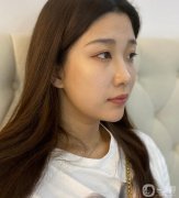 我也想了很久，決定過(guò)來(lái)做一個(gè)黃金微雕吸脂來(lái)解決我的問(wèn)題