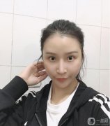 減脂很難，也瘦不了多少，所以面部吸脂真的幫了我很多