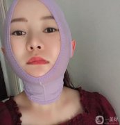 我在下部做了吸臉和線雕，解決了臉上脂肪厚度和皮脂下垂的問題