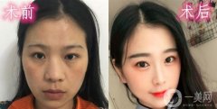 我一直不太喜歡我的大鼻子，它看起來又扁又平，沒有弧度