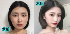術(shù)后16天，拆線后眼睛真的恢復(fù)的比較快