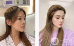 想了很久，攢了很久的錢，終于如愿在醫(yī)院做了個(gè)鼻子