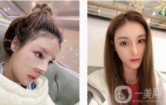 現(xiàn)在鼻子弧度還是很好的，山根自然消失，在原來的基礎(chǔ)上增加1 mm以上