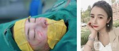 隆鼻、面部填充已經(jīng)快一個月了，現(xiàn)在鼻子恢復情況比前兩周好了很多