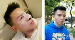 來(lái)醫(yī)院面診后，醫(yī)生給我做鼻子合成的建議，腫脹的耳軟骨墊托起了鼻子鼻頭縮