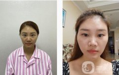 埋線雙眼皮手術(shù)后，我覺(jué)得每天照鏡子成了我不可或缺的例行公事