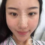 這個(gè)丑鼻子降低了我的面值，我想做手術(shù)