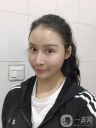 我早就想做面部吸脂了，我去過很多家，也咨詢過醫(yī)院
