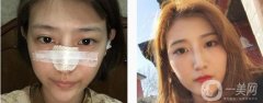 所以很多人對(duì)自己的鼻子不滿意，甚至有人選擇做隆鼻來達(dá)到美觀的效果
