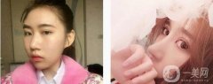 我做了一次全面的鼻子整形手術(shù)，因?yàn)槲铱傆X得鼻子塌在山根，整個(gè)鼻子看起來